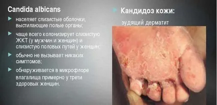 Candida albicans (кандида альбіканс) у чоловіків, жінок і дітей (альбіканс) Candida albicans (кандида альбіканс) у чоловіків, жінок і дітей