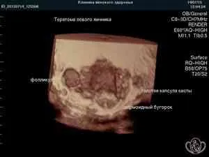 Чим відрізняється кіста від кістоми - пухлини і запалення - каталог статей - жіноче здоров'я і (кістоми) Чим відрізняється кіста від кістоми - пухлини і запалення - каталог статей - жіноче здоров'я і