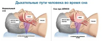 Чим небезпечний хропіння уві сні і які наслідки (небезпечний) Чим небезпечний хропіння уві сні і які наслідки