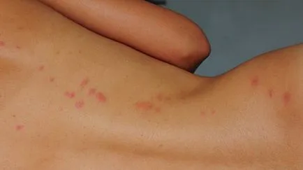 Чим небезпечні клопи для людини і якої шкоди вони несуть (клопи) Чим небезпечні клопи для людини і якої шкоди вони несуть