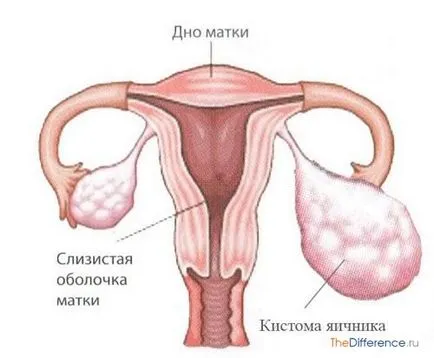 Чим відрізняється кіста від кістоми (відрізняється кіста кістоми) Чим відрізняється кіста від кістоми