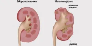 Що робити якщо болять нирки після алкоголю, як лікувати (нирки) Що робити якщо болять нирки після алкоголю, як лікувати