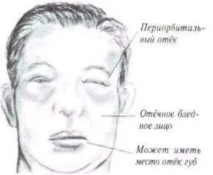 Що робити якщо болять нирки після алкоголю, як лікувати (робити) Що робити якщо болять нирки після алкоголю, як лікувати