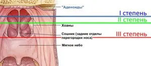 Що таке аденоїди симптоми і ознаки захворювання, стадії і лікування (таке) Що таке аденоїди симптоми і ознаки захворювання, стадії і лікування