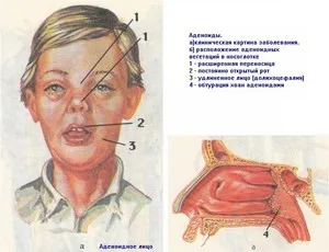 Що таке аденоїди симптоми і ознаки захворювання, стадії і лікування (симптоми) Що таке аденоїди симптоми і ознаки захворювання, стадії і лікування