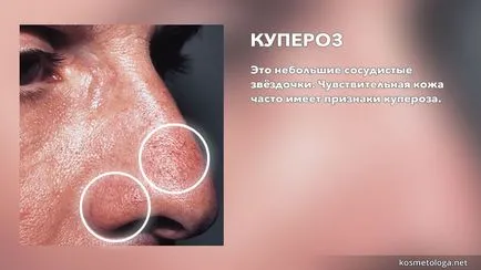Чутлива шкіра і купероз - секрети правильного догляду (чутлива) Чутлива шкіра і купероз - секрети правильного догляду