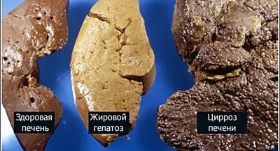 Цироз печінки причини і від чого буває