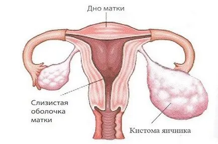 Цистаденома яєчника види (серозна, папілярна, муцинозная та інші), симптоми, діагностика,