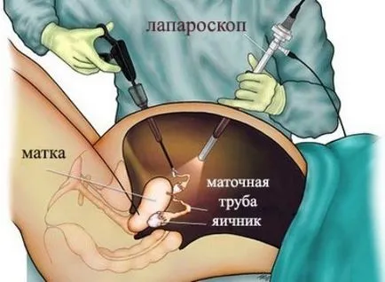 Цистаденома яєчника види (серозна, папілярна, муцинозная та інші), симптоми, діагностика,