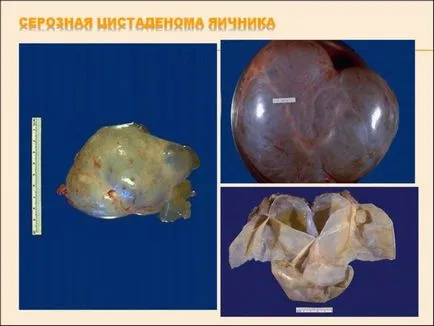 Цистаденома яєчника види (серозна, папілярна, муцинозная та інші), симптоми, діагностика,