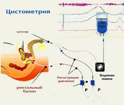 Цистометрія (цистоманометрія)