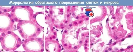 Що таке некроз морфологія некрозу (Некротические клітини можуть) Що таке некроз морфологія некрозу