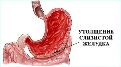 Що таке ремісія при хронічному гастриті і як її лікувати (гастриті) Що таке ремісія при хронічному гастриті і як її лікувати