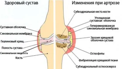 Що таке фонофорез з гідрокортизоном, протипоказання (фонофорез) Що таке фонофорез з гідрокортизоном, протипоказання