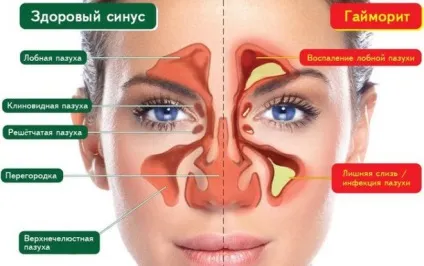Що таке фонофорез з гідрокортизоном, протипоказання (фонофорез) Що таке фонофорез з гідрокортизоном, протипоказання