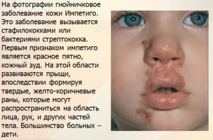 Що таке імпетиго, симптоми і як проходить лікування (лікування) Що таке імпетиго, симптоми і як проходить лікування
