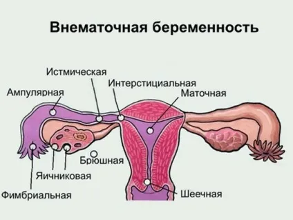 Що таке сольовий аборт