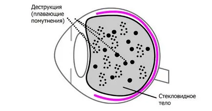 Деструкція склоподібного тіла ока - симптоми і лікування (склоподібного) Деструкція склоподібного тіла ока - симптоми і лікування