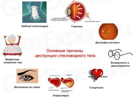 Деструкція склоподібного тіла ока - симптоми і лікування (очі) Деструкція склоподібного тіла ока - симптоми і лікування