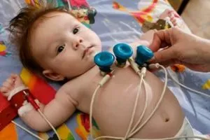 Диспластична кардиопатия причини, симптоми, діагностика, лікування (діагностика) Диспластична кардиопатия причини, симптоми, діагностика, лікування