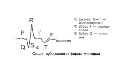 ЕКГ при інфаркті міокарда