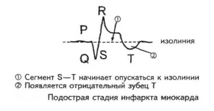 ЕКГ при інфаркті міокарда