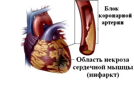 ЕКГ при інфаркті міокарда