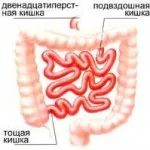 Ентерит симптоми і лікування (гострий і хронічний) (лікування) Ентерит симптоми і лікування (гострий і хронічний)