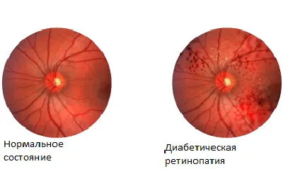 Фонова ретинопатія і ретинальні судинні зміни що це таке, симптоми і лікування (фонова) Фонова ретинопатія і ретинальні судинні зміни що це таке, симптоми і лікування