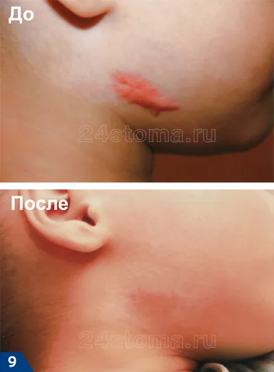 Ферменкол гель - інструкція із застосування, ціна, відгуки від рубців (гель) Ферменкол гель - інструкція із застосування, ціна, відгуки від рубців