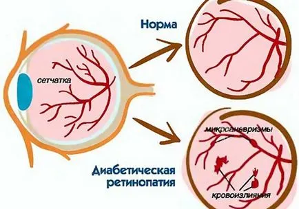 Фонова ретинопатія і ретинальні судинні зміни що це таке, симптоми і лікування (зміни) Фонова ретинопатія і ретинальні судинні зміни що це таке, симптоми і лікування