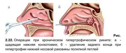 Гіпертрофічний риніт гострий і хронічний - симптоми і лікування у дорослих і дітей ліками, (риніт) Гіпертрофічний риніт гострий і хронічний - симптоми і лікування у дорослих і дітей ліками,