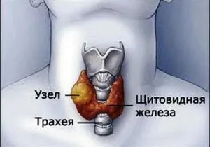Гарячий вузол щитовидної залози характеристика, симптоми, лікування (гарячий) Гарячий вузол щитовидної залози характеристика, симптоми, лікування