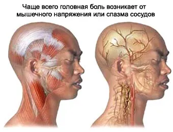 Головний біль