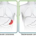 Інфаркт селезінки причини, симптоми, діагностика, лікування