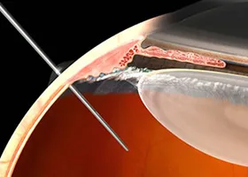 Інтравітреальні ін'єкції - офтальмологічний центр ophthalmica (офтальмологи салоніки) Інтравітреальні ін'єкції - офтальмологічний центр ophthalmica