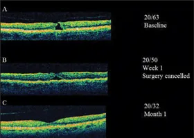 Інтравітреальні ін'єкції - офтальмологічний центр ophthalmica (офтальмолог салоніки) Інтравітреальні ін'єкції - офтальмологічний центр ophthalmica