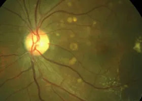 Інтравітреальні ін'єкції - офтальмологічний центр ophthalmica (офтальмологічний центр салоніки) Інтравітреальні ін'єкції - офтальмологічний центр ophthalmica