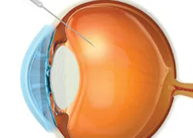 Інтравітреальні ін'єкції - офтальмологічний центр ophthalmica (інтравітреальні) Інтравітреальні ін'єкції - офтальмологічний центр ophthalmica