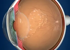Інтравітреальні ін'єкції - офтальмологічний центр ophthalmica (інтравітреальні) Інтравітреальні ін'єкції - офтальмологічний центр ophthalmica