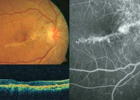 Інтравітреальні ін'єкції - офтальмологічний центр ophthalmica (ін'єкції) Інтравітреальні ін'єкції - офтальмологічний центр ophthalmica
