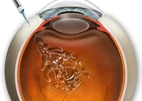 Інтравітреальні ін'єкції - офтальмологічний центр ophthalmica (допомогою інтравітреальних ін'єкцій) Інтравітреальні ін'єкції - офтальмологічний центр ophthalmica