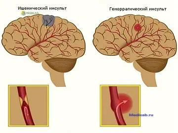 Інсульт симптоми, лікування і профілактика захворювання (лікування) Інсульт симптоми, лікування і профілактика захворювання