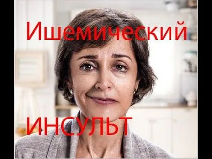 Інсульт перші ознаки і симптоми (інсульт) Інсульт перші ознаки і симптоми