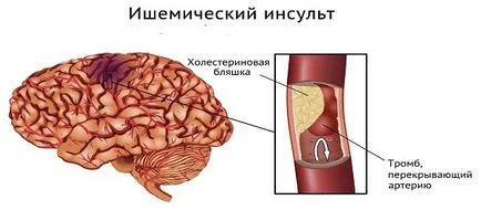 Ішемічіскій інсульт причини і провокуючі фактори (чинники) Ішемічіскій інсульт причини і провокуючі фактори