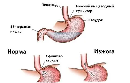 Печія - що це таке, як вона відчувається (таке) Печія - що це таке, як вона відчувається