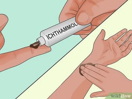 Як безболісно витягти скалку (скалку) Як безболісно витягти скалку