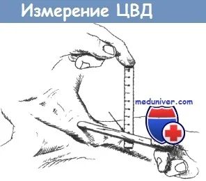 Як виміряти центральний венозний тиск (ЦВТ) при огляді (виміряти) Як виміряти центральний венозний тиск (ЦВТ) при огляді