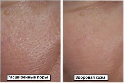 Як позбутися чорних крапок і звузити пори (чорних) Як позбутися чорних крапок і звузити пори