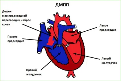 Дефект міжпередсердної перегородки (вроджений порок серця) - вторинний, операція, у новонароджених